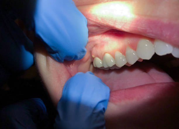 Best Lost Filling or Crown Replacement in Montezuma, IA